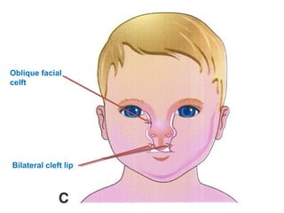 Development of Face, Nose and Palate (Special Embryology) | PPT