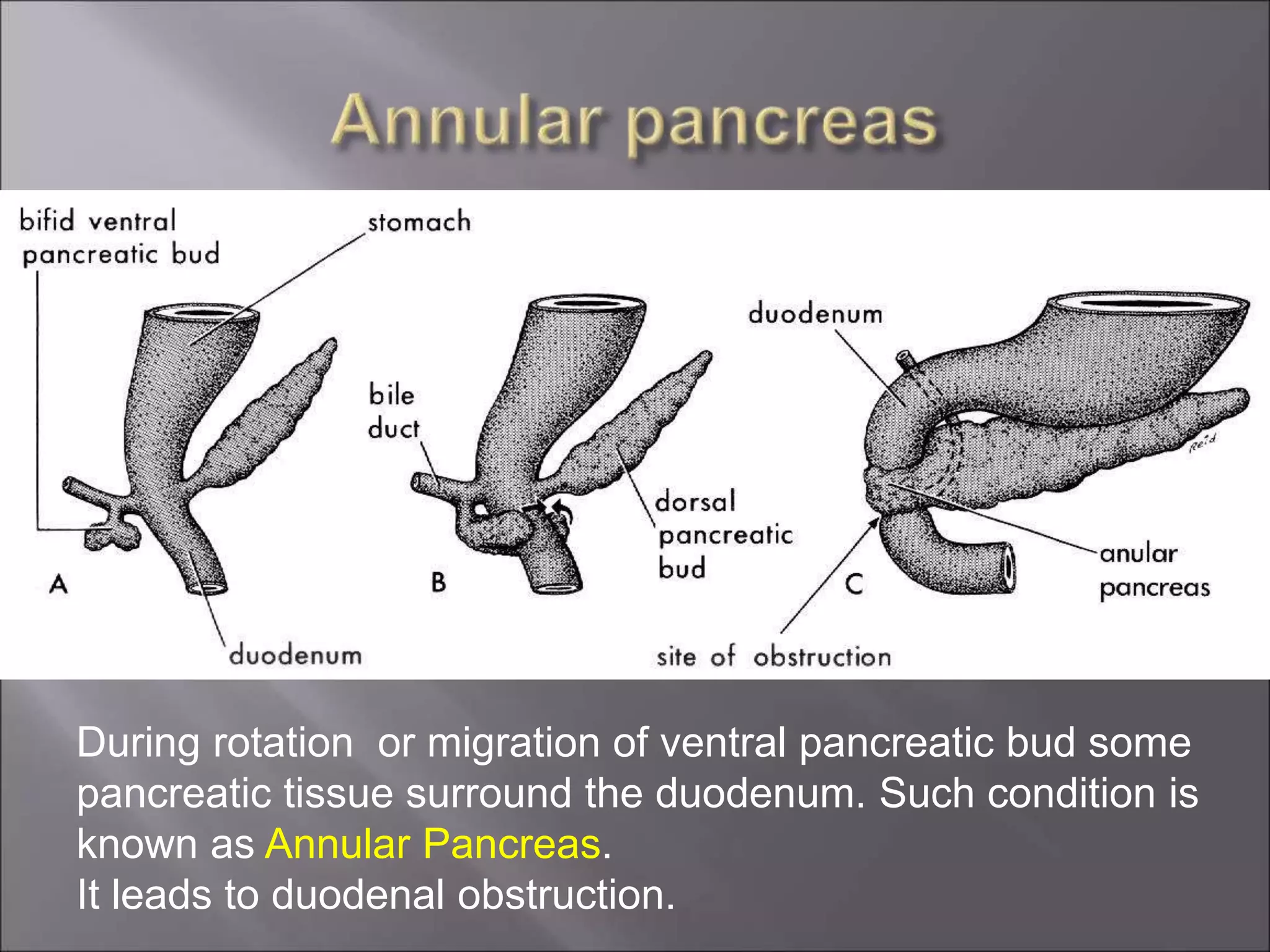 During rotation or migration of ventral pancreatic bud some
pancreatic tissue surround the duodenum. Such condition is
known as Annular Pancreas.
It leads to duodenal obstruction.
 