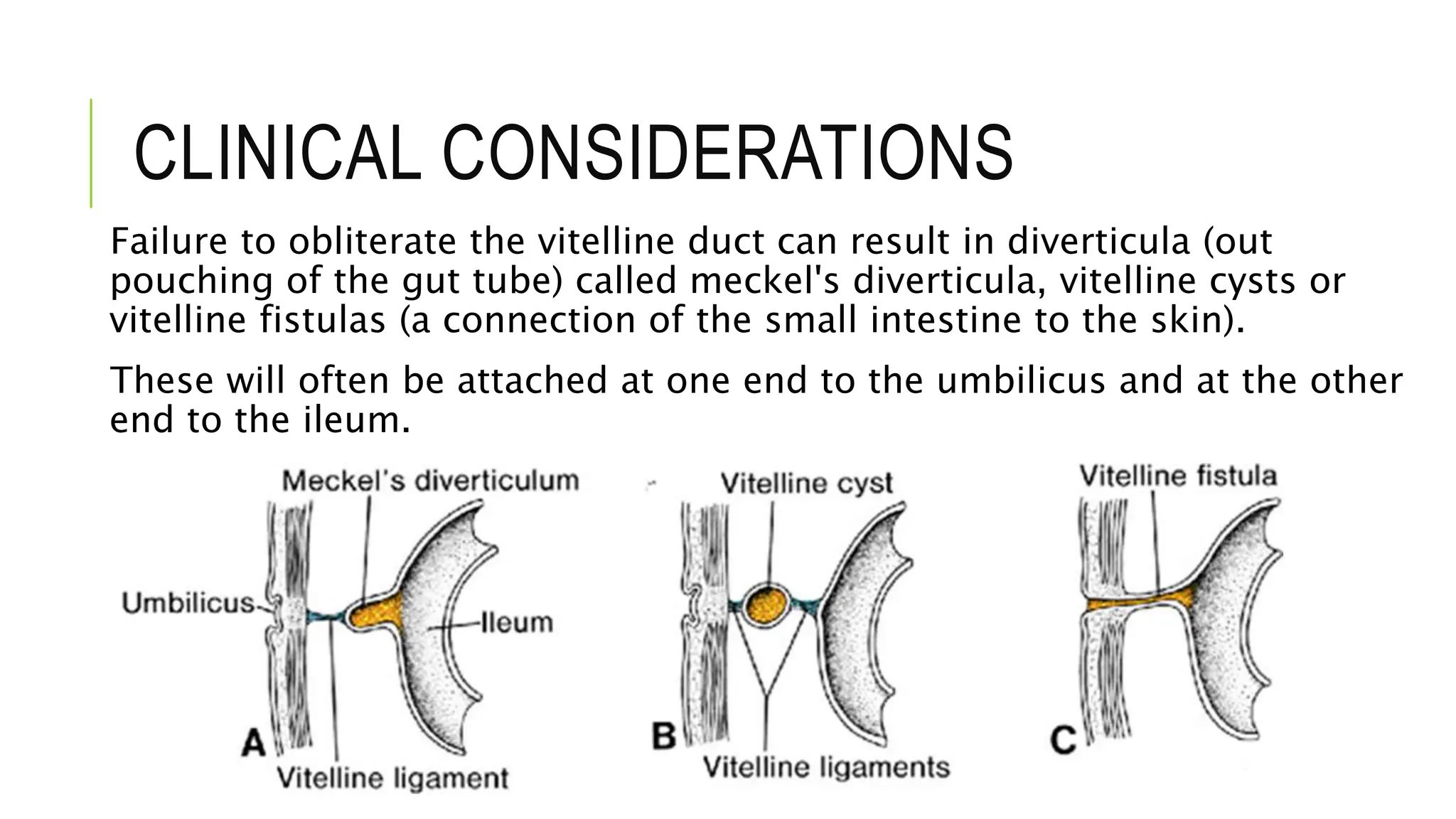CLINICAL CONSIDERATIONS
Failure to obliterate the vitelline duct can result in diverticula (out
pouching of the gut tube) called meckel's diverticula, vitelline cysts or
vitelline fistulas (a connection of the small intestine to the skin).
These will often be attached at one end to the umbilicus and at the other
end to the ileum.
 