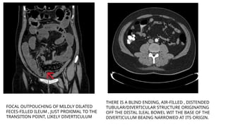 FOCAL OUTPOUCHING OF MILDLY DILATED
FECES-FILLED ILEUM , JUST PROXIMAL TO THE
TRANSITION POINT, LIKELY DIVERTICULUM
THERE IS A BLIND ENDING, AIR-FILLED , DISTENDED
TUBULAR/DIVERTICULAR STRUCTURE ORIGINATING
OFF THE DISTAL ILEAL BOWEL WIT THE BASE OF THE
DIVERTICULUM BEAING NARROWED AT ITS ORIGIN.
 