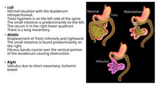 • Left
Normal situation with the duodenum
retroperitoneal.
Treitz ligament is on the left side of the spine.
The small intestine is predominantly on the left.
The cecum is in the right lower quadrant
There is a long mesentery.
• Middle
Displacement of Treitz inferiorly and rightward.
The small intestine is found predominantly on
the right.
Fibrous bands course over the vertical portion
of the duodenum causing obstruction.
• Right
Volvulus due to short mesentery. Ischemic
bowel.
 