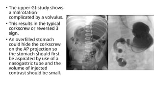 • The upper GI-study shows
a malrotation
complicated by a volvulus.
• This results in the typical
corkscrew or reversed 3
sign.
• An overfilled stomach
could hide the corkscrew
on the AP projection so
the stomach should first
be aspirated by use of a
nasogastric tube and the
volume of injected
contrast should be small.
 