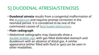 5] DUODENAL ATRESIA/STENOSIS
• Duodenal atresia results from a congenital malformation of
the duodenum and requires prompt correction in the
neonatal period. It is considered to be one of the
commonest causes of fetal bowel obstruction.
• Plain radiograph
• Abdominal radiographs may classically show a
double bubble sign with gas filled distended stomach and
duodenum with an absence of distal gas. A similar
appearance (either filled with fluid or gas) can be seen in
other modalities.
 
