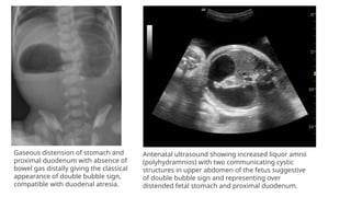 Gaseous distension of stomach and
proximal duodenum with absence of
bowel gas distally giving the classical
appearance of double bubble sign,
compatible with duodenal atresia.
Antenatal ultrasound showing increased liquor amnii
(polyhydramnios) with two communicating cystic
structures in upper abdomen of the fetus suggestive
of double bubble sign and representing over
distended fetal stomach and proximal duodenum.
 