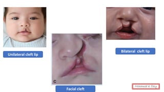 Unilateral cleft lip
Bilateral cleft lip
Facial cleft
Mohamed el fiky
 