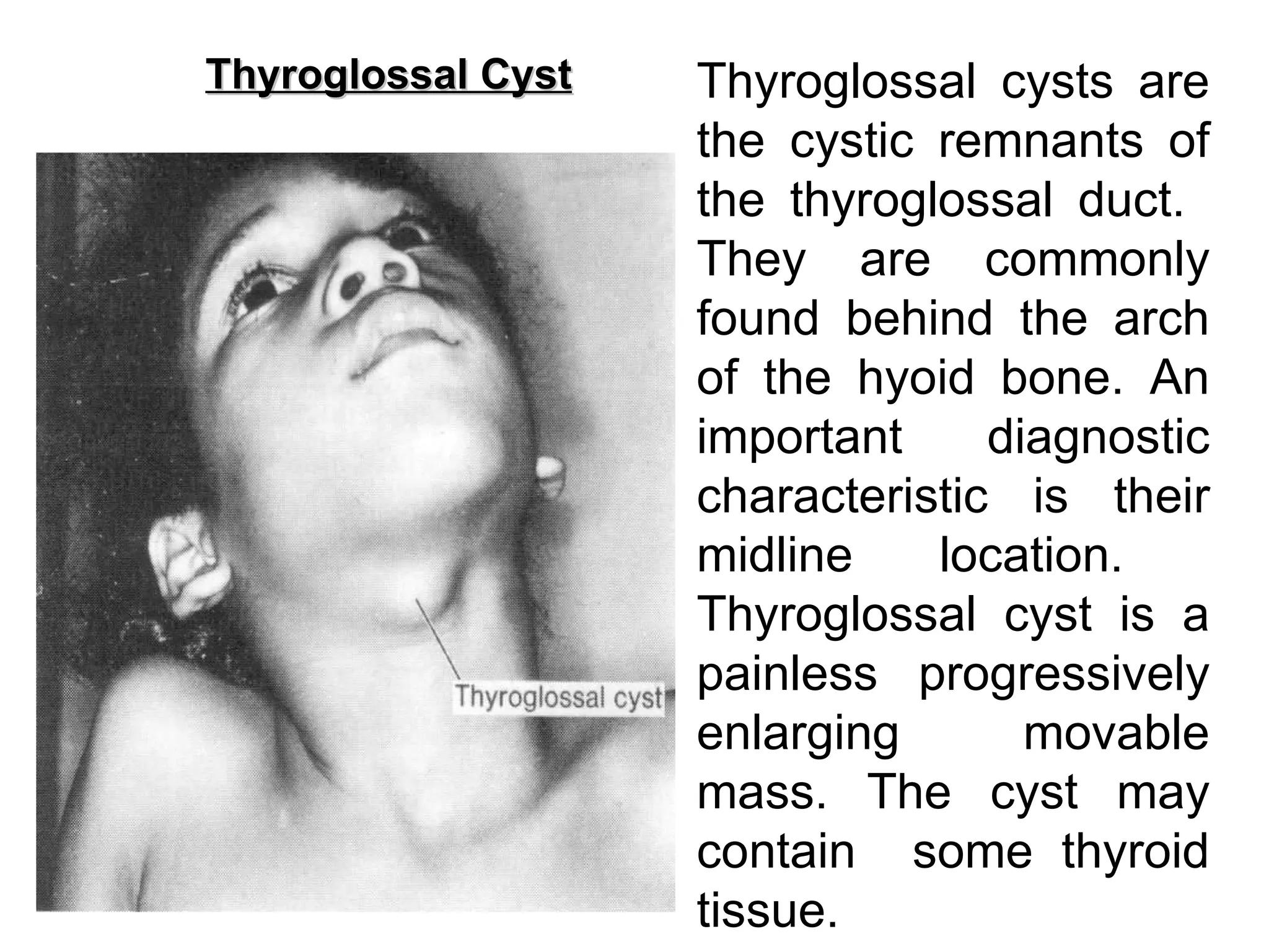Thyroglossal Cyst Thyroglossal cysts are the cystic remnants of the thyroglossal duct.  They are commonly found behind the arch of the hyoid bone. An important diagnostic characteristic is their midline location.  Thyroglossal cyst is a painless progressively enlarging movable mass.   The cyst may contain  some thyroid tissue.  