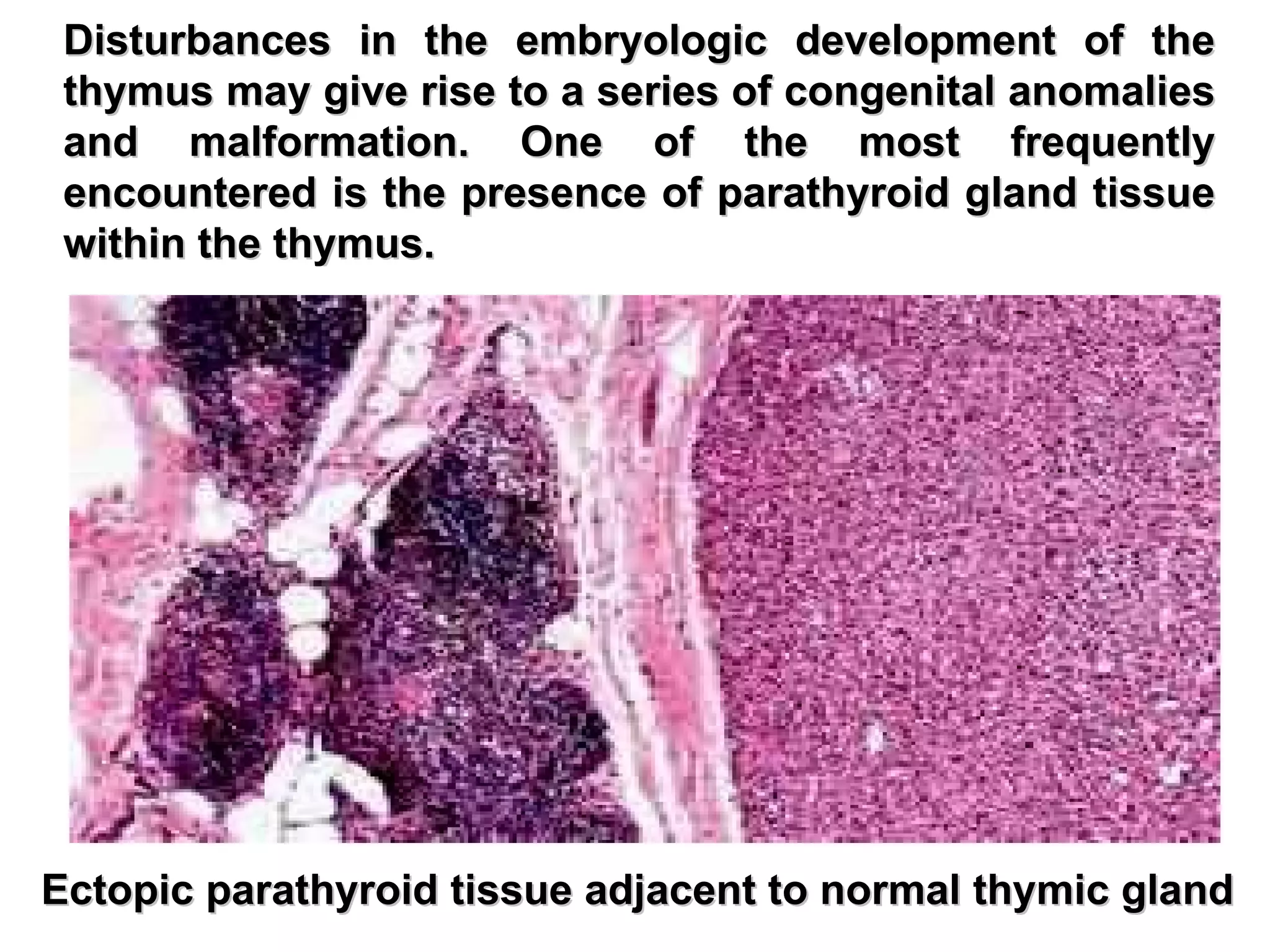 Disturbances in the embryologic development of the thymus may give rise to a series of congenital anomalies and malformation. One of the most frequently encountered is the presence of parathyroid gland tissue within the thymus. Ectopic parathyroid tissue adjacent to normal thymic gland 