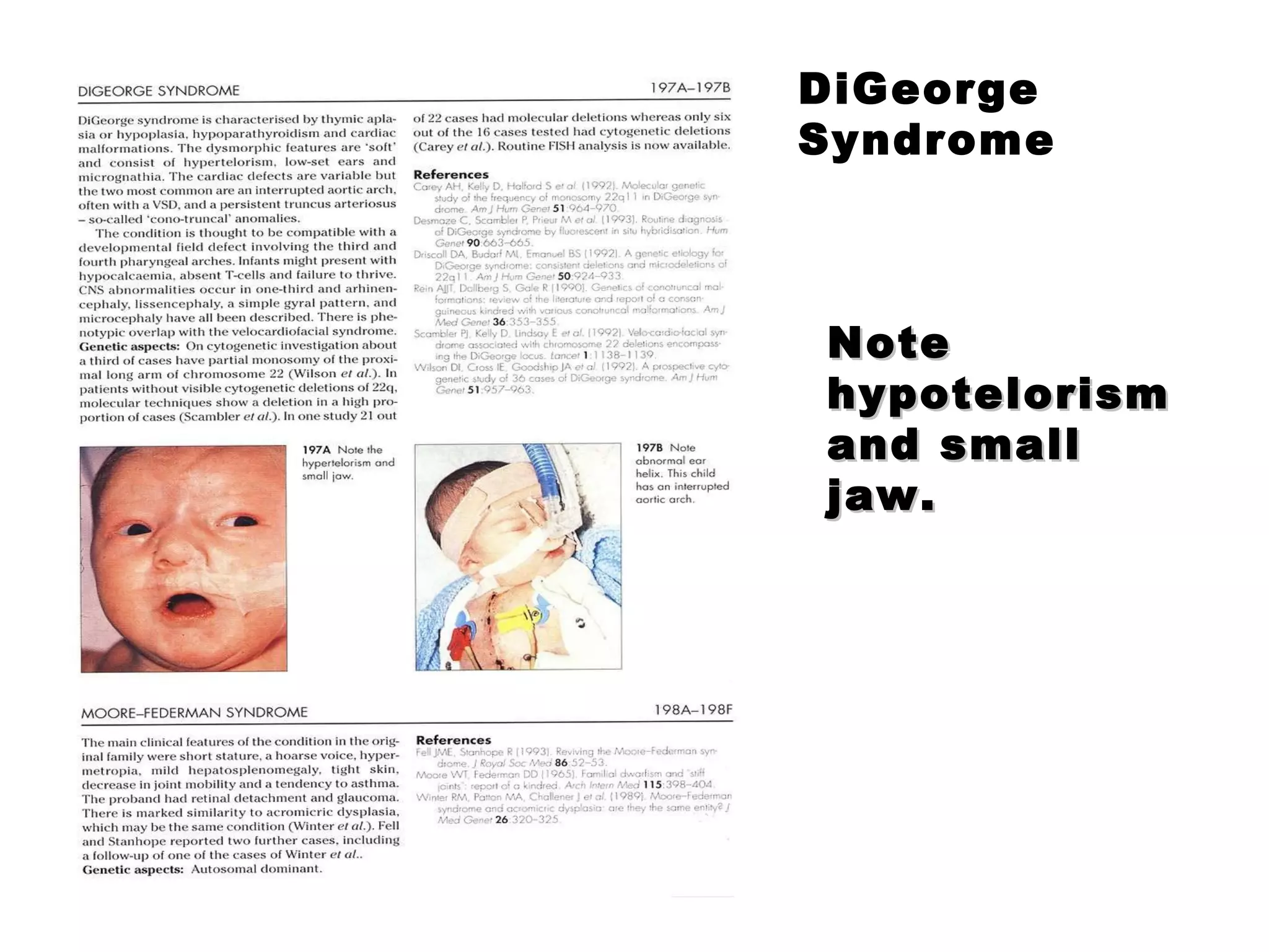 DiGeorge Syndrome Note hypotelorism and small jaw. 