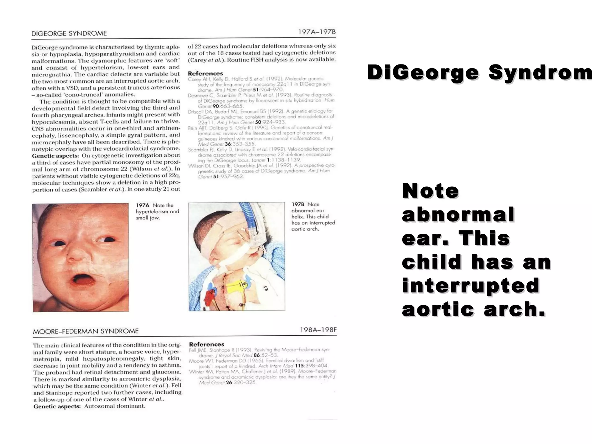 DiGeorge Syndrome Note abnormal ear. This child has an interrupted aortic arch. 