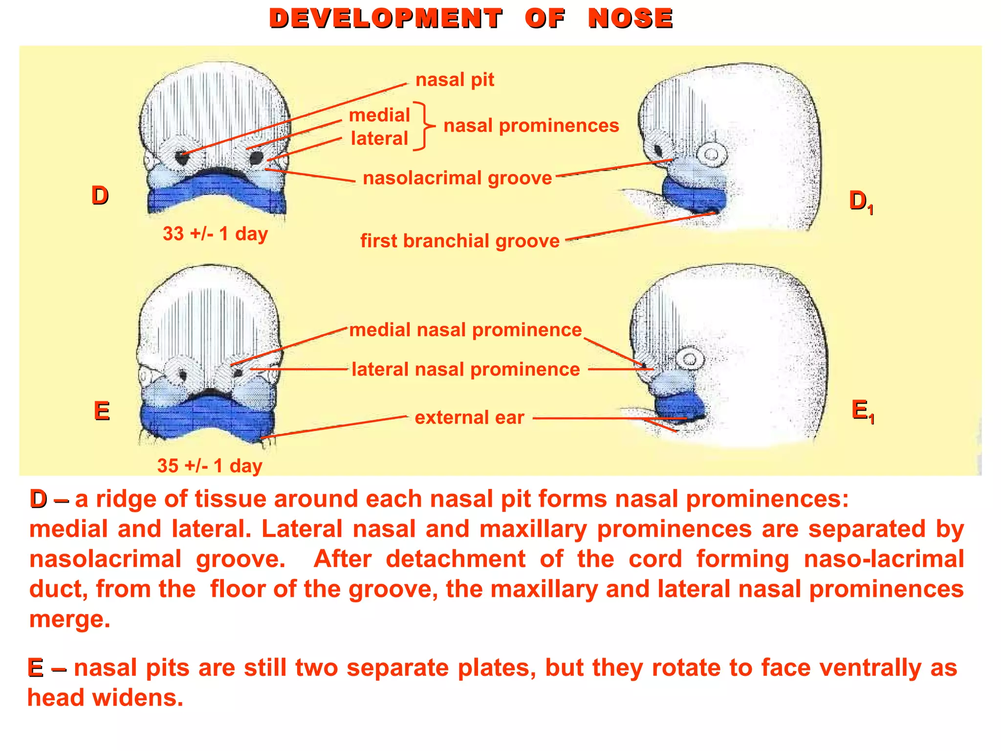 DEVELOPMENT  OF  NOSE E –  n asal pits are still two separate plates, but they rotate to face ventrally as head widens.  D –  a ridge of tissue around each nasal pit forms nasal prominences: medial and lateral. Lateral nasal and maxillary prominences are separated by nasolacrimal groove.  After detachment of the cord forming naso-lacrimal duct, from the  floor of the groove, the maxillary and lateral nasal prominences merge. nasal pit medial lateral nasal prominences nasolacrimal groove first branchial groove medial nasal prominence lateral nasal prominence external ear D E D 1 E 1 33 +/- 1 day 35 +/- 1 day 