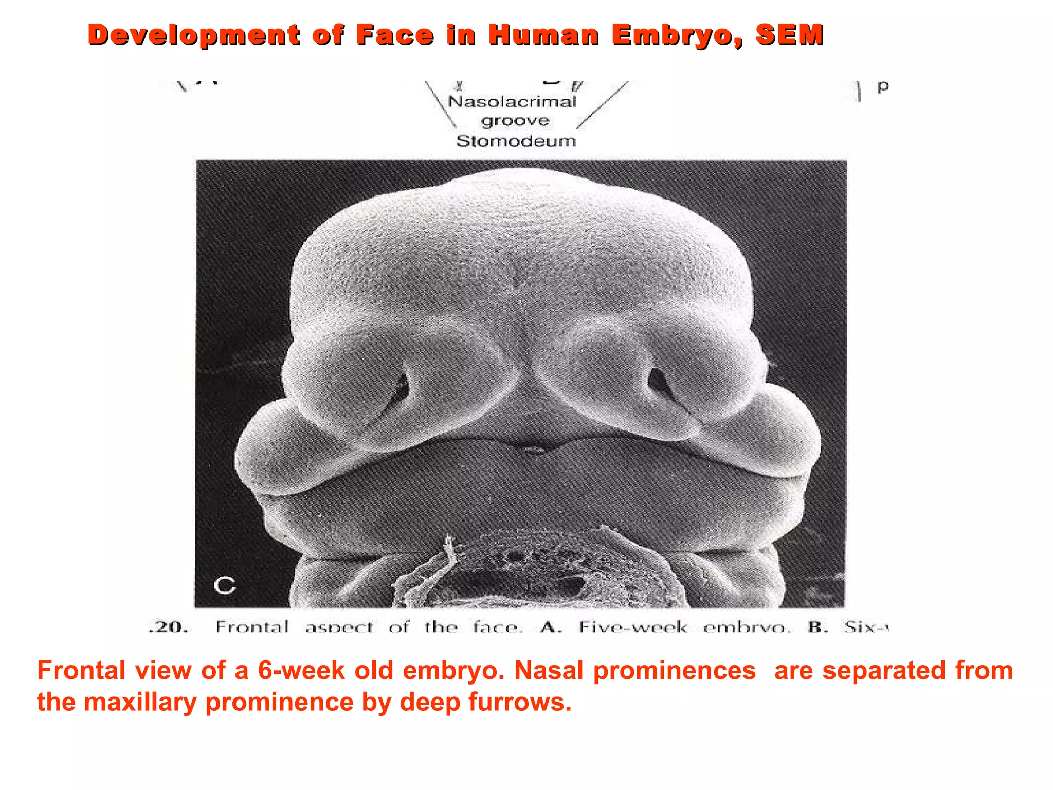 Development of Face in Human Embryo, SEM  Frontal view of a 6-week old embryo. Nasal prominences  are separated from the maxillary prominence by deep furrows.  