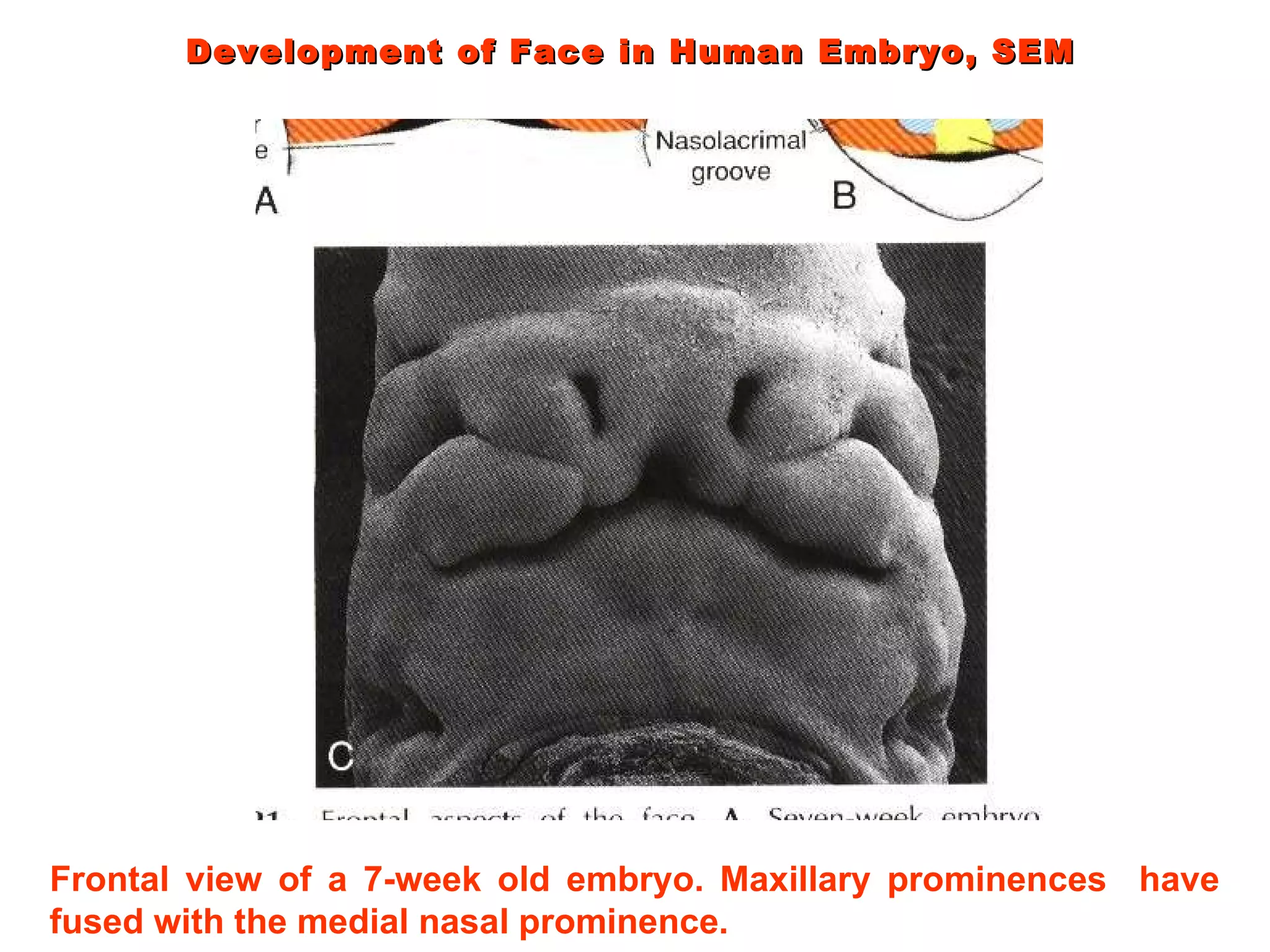 Development of Face in Human Embryo, SEM Frontal view of a 7-week old embryo. Maxillary prominences  have fused with the medial nasal prominence. 