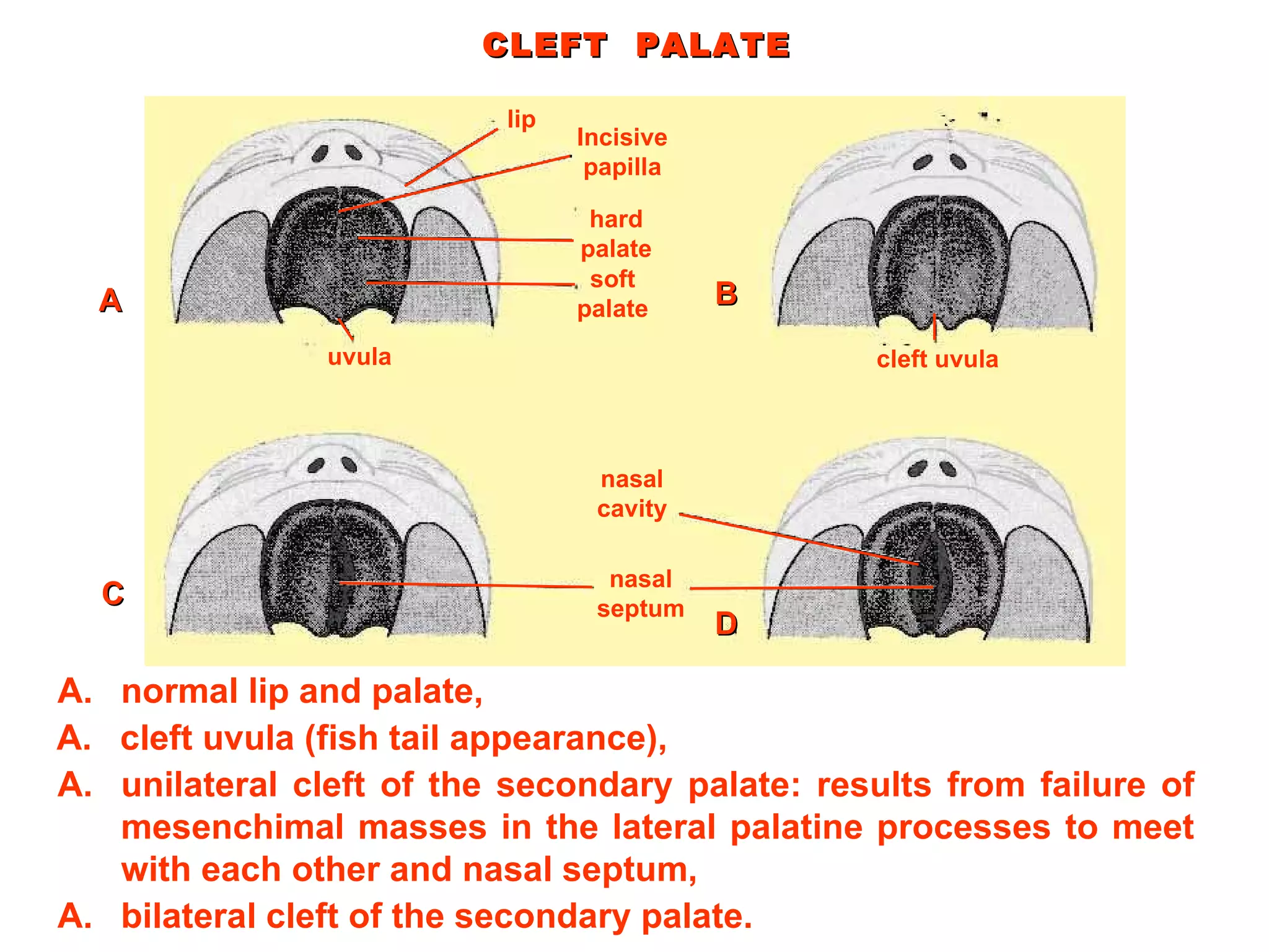 CLEFT  PALATE lip Incisive papilla hard palate soft palate uvula cleft uvula nasal cavity nasal septum normal lip and palate,  A cleft uvula (fish tail appearance), B unilateral cleft of the secondary palate: results from failure of   mesenchimal masses in the lateral palatine processes to meet   with   each other and nasal septum, C bilateral cleft of the secondary palate. D 