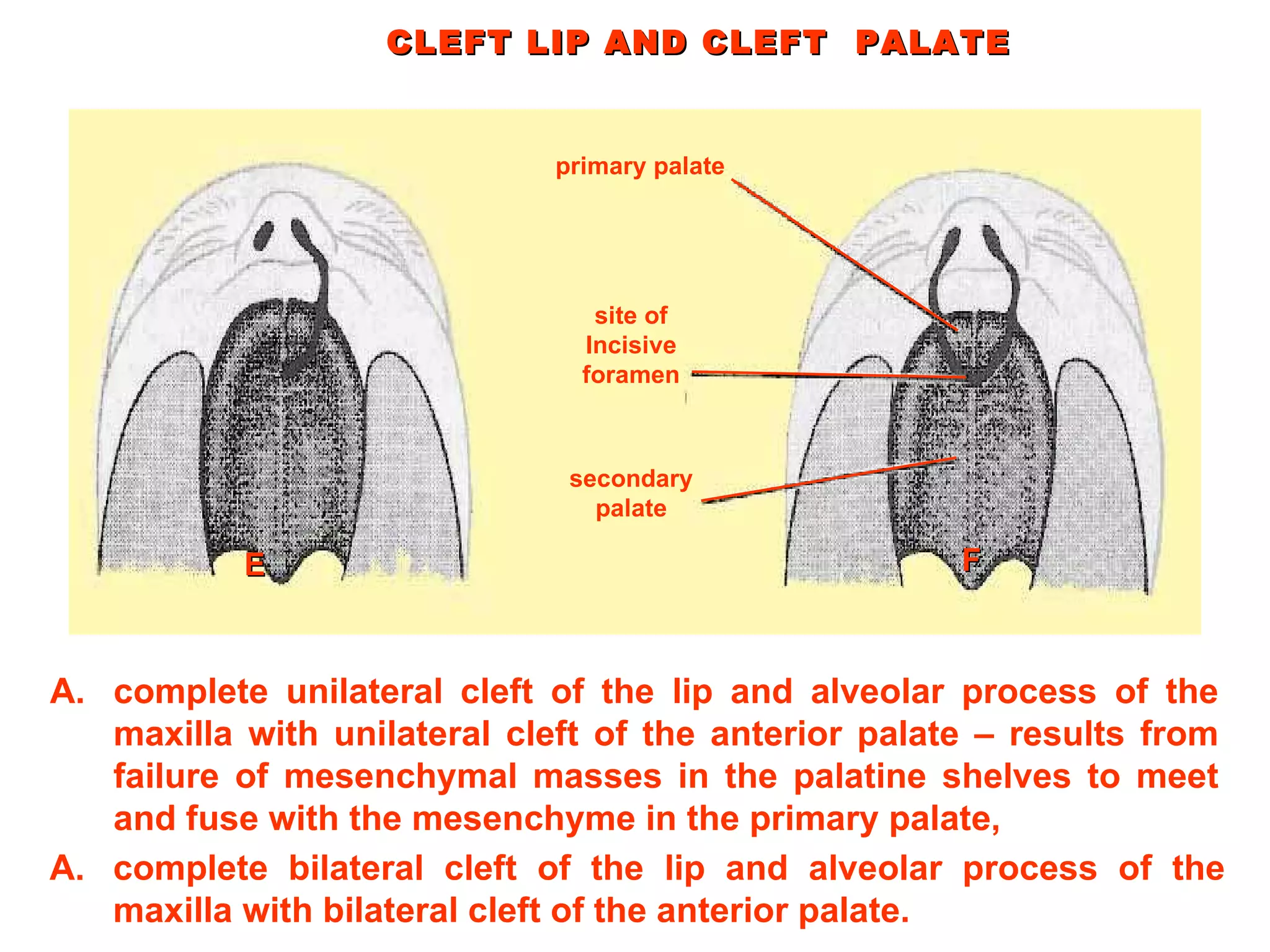 CLEFT LIP AND CLEFT  PALATE primary palate site of Incisive foramen secondary palate complete unilateral cleft of the lip and alveolar process of the maxilla with unilateral cleft of the anterior palate – results from failure of mesenchymal masses in the palatine shelves to meet and fuse with the mesenchyme in the primary palate, E complete bilateral cleft of the lip and alveolar process of the maxilla with bilateral cleft of the anterior palate.  F 