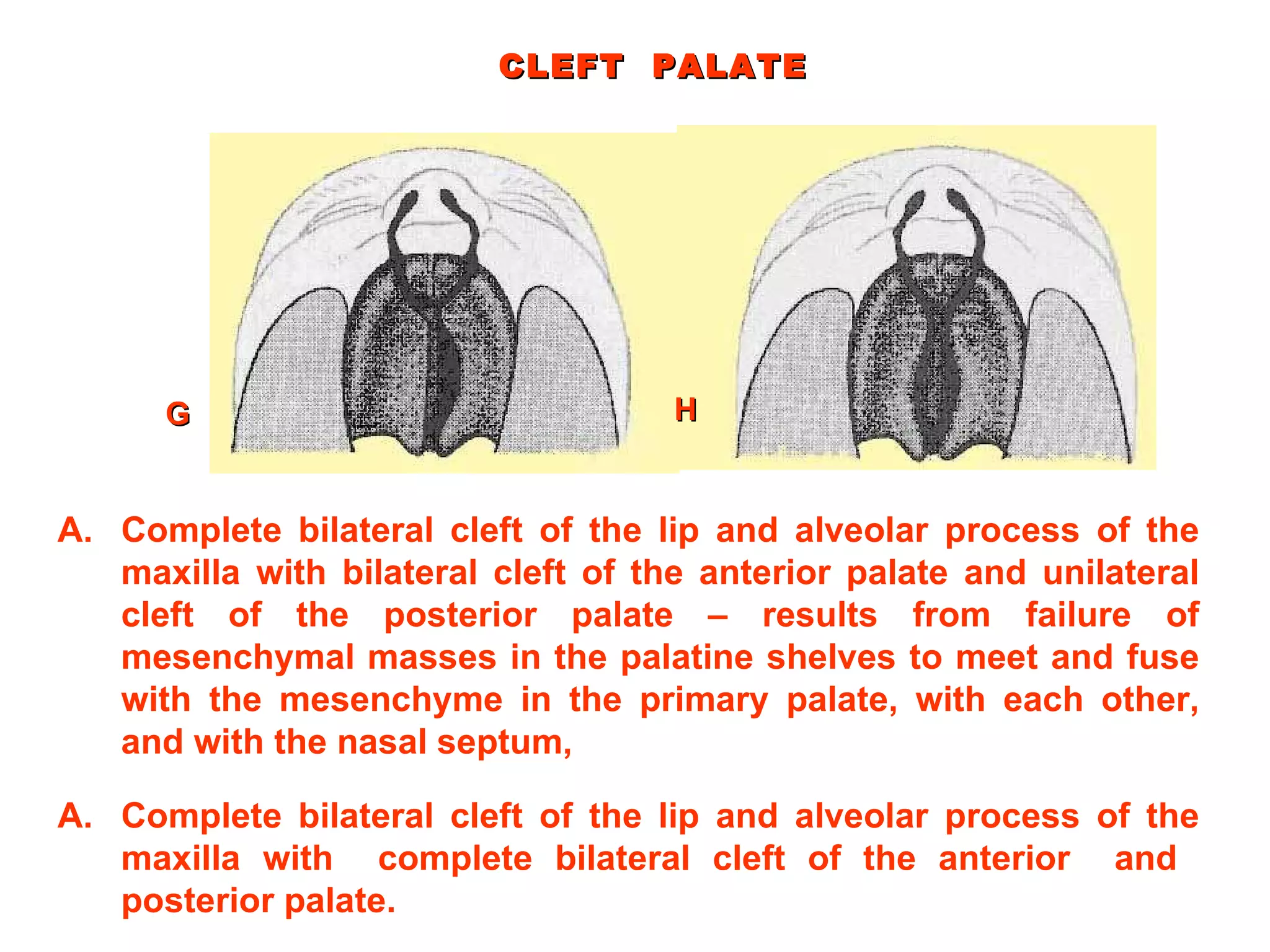 CLEFT  PALATE Complete bilateral cleft of the lip and alveolar process of the maxilla with bilateral cleft of the anterior palate and unilateral cleft of the posterior palate – results from failure of mesenchymal masses in the palatine shelves to meet and fuse with the mesenchyme in the primary palate, with each other, and with the nasal septum, G Complete bilateral cleft of the lip and alveolar process of the maxilla with  complete bilateral cleft of the anterior  and  posterior palate.  H 