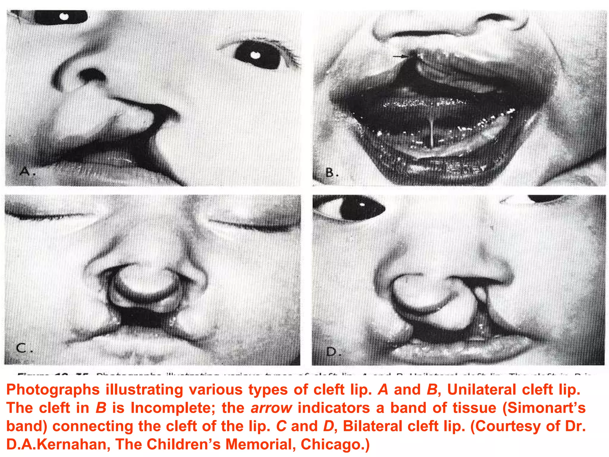 Photographs illustrating various types of cleft lip.  A  and  B , Unilateral cleft lip.  The cleft in  B  is Incomplete; the  arrow  indicators a band of tissue (Simonart’s band) connecting the cleft of the lip.  C  and  D , Bilateral cleft lip. (Courtesy of Dr. D.A.Kernahan, The Children’s Memorial, Chicago.) 