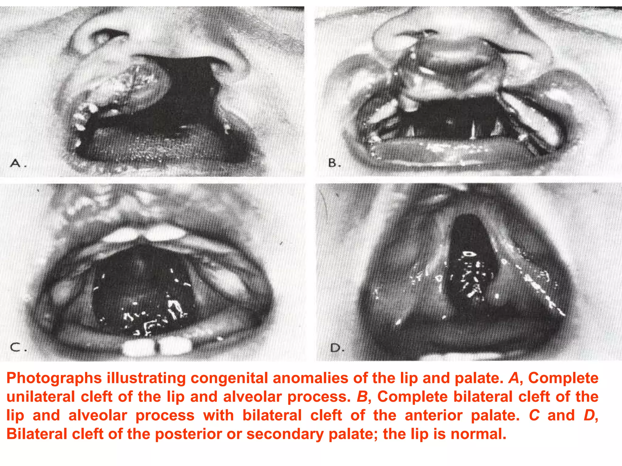 Photographs illustrating congenital anomalies of the lip and palate.  A , Complete unilateral cleft of the lip and alveolar process.  B , Complete bilateral cleft of the lip and alveolar process with bilateral cleft of the anterior palate.  C  and  D , Bilateral cleft of the posterior or secondary palate; the lip is normal. 