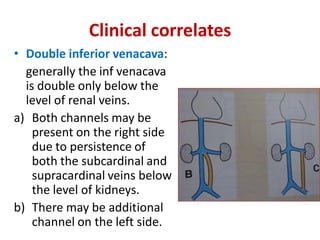 Clinical correlates
• Double inferior venacava:
generally the inf venacava
is double only below the
level of renal veins.
a) Both channels may be
present on the right side
due to persistence of
both the subcardinal and
supracardinal veins below
the level of kidneys.
b) There may be additional
channel on the left side.
 