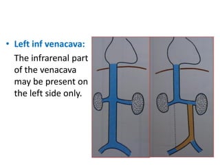 • Left inf venacava:
The infrarenal part
of the venacava
may be present on
the left side only.
 