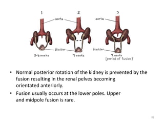 Kidney Rotation Development of kidney & its anomalies | PPTX