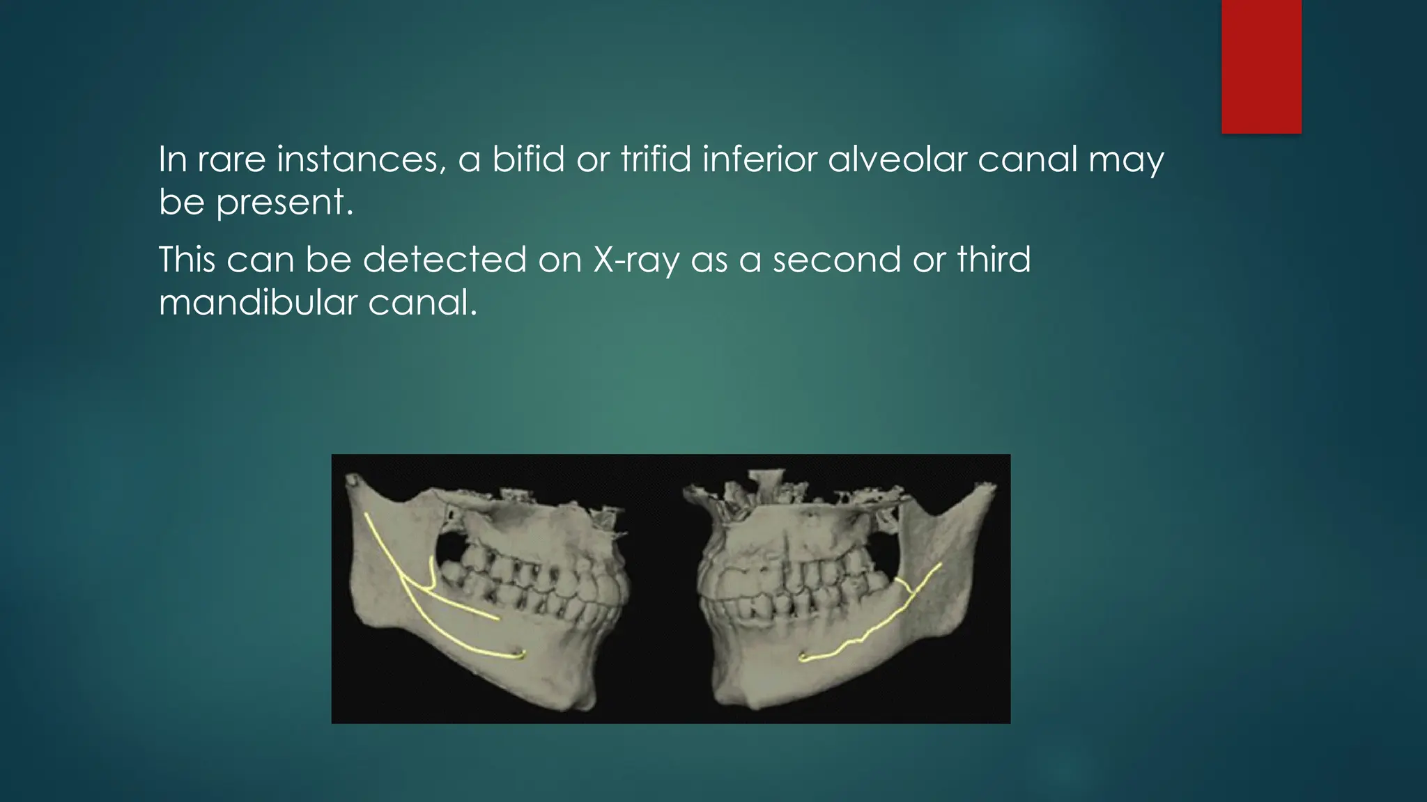 In rare instances, a bifid or trifid inferior alveolar canal may
be present.
This can be detected on X-ray as a second or third
mandibular canal.
 