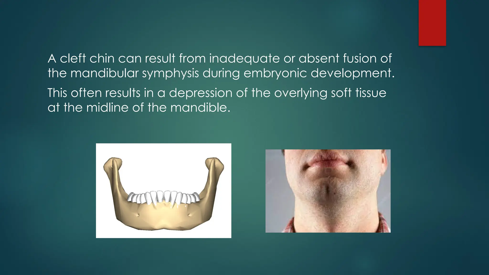 A cleft chin can result from inadequate or absent fusion of
the mandibular symphysis during embryonic development.
This often results in a depression of the overlying soft tissue
at the midline of the mandible.
 