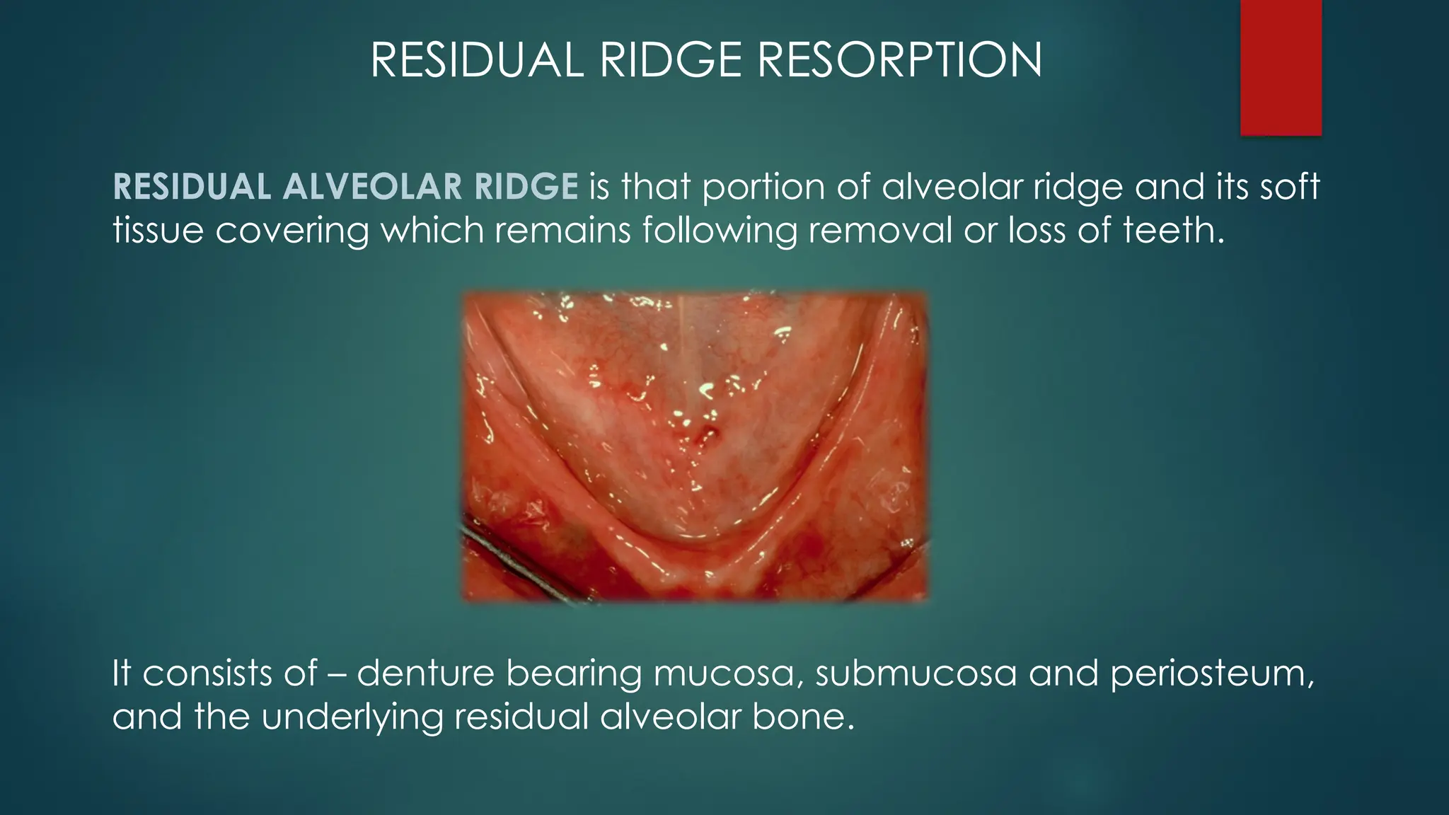 RESIDUAL RIDGE RESORPTION
RESIDUAL ALVEOLAR RIDGE is that portion of alveolar ridge and its soft
tissue covering which remains following removal or loss of teeth.
It consists of – denture bearing mucosa, submucosa and periosteum,
and the underlying residual alveolar bone.
 