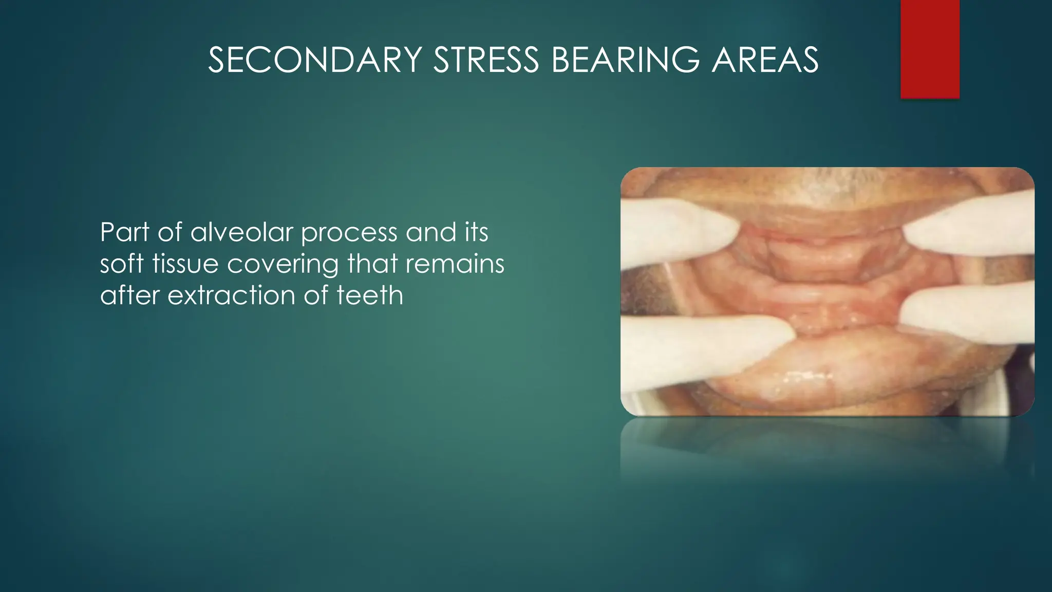 SECONDARY STRESS BEARING AREAS
Part of alveolar process and its
soft tissue covering that remains
after extraction of teeth
 