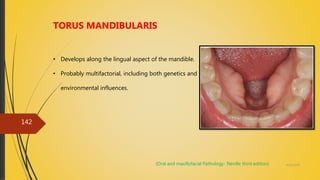 4/14/2018
142
TORUS MANDIBULARIS
• Develops along the lingual aspect of the mandible.
• Probably multifactorial, including both genetics and
environmental influences.
(Oral and maxillofacial Pathology- Neville third edition)
 