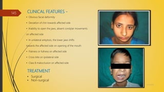 CLINICAL FEATURES -
4/14/2018
145
• Obvious facial deformity
• Deviation of chin towards affected side
• Inability to open the jaws, absent condylar movements
on affected side
• In unilateral ankylosis, the lower jaws shifts
towards the affected side on opening of the mouth
• Flatness or fullness on affected side
• Cross bite on ipsilateral side
• Class II malocclusion on affected side
TREATMENT
• Surgical
• Non-surgical
 