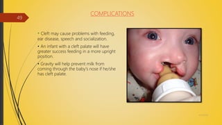 COMPLICATIONS
• Cleft may cause problems with feeding,
ear disease, speech and socialization.
• An infant with a cleft palate will have
greater success feeding in a more upright
position.
• Gravity will help prevent milk from
coming through the baby's nose if he/she
has cleft palate.
4/14/2018
49
 