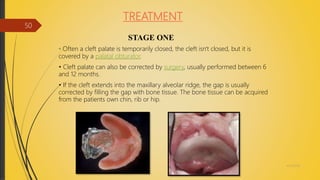 TREATMENT
STAGE ONE
• Often a cleft palate is temporarily closed, the cleft isn't closed, but it is
covered by a palatal obturator.
• Cleft palate can also be corrected by surgery, usually performed between 6
and 12 months.
• If the cleft extends into the maxillary alveolar ridge, the gap is usually
corrected by filling the gap with bone tissue. The bone tissue can be acquired
from the patients own chin, rib or hip.
4/14/2018
50
 