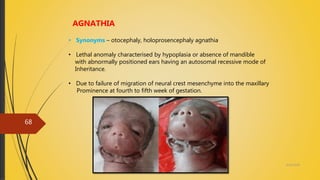 4/14/2018
68
AGNATHIA
• Synonyms – otocephaly, holoprosencephaly agnathia
• Lethal anomaly characterised by hypoplasia or absence of mandible
with abnormally positioned ears having an autosomal recessive mode of
Inheritance.
• Due to failure of migration of neural crest mesenchyme into the maxillary
Prominence at fourth to fifth week of gestation.
 