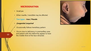4/14/2018
69
MICROGNATHIA
• Small jaw
• Either maxilla / mandible may be affected.
• Two types – true / Pseudo
• Congenital /acquired
• Occasionally follows hereditary pattern
• Occurs due to deficiency in premaxillary area
and patient with this deformity appear to have
the middle third of the face retracted.
 