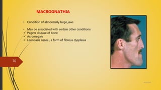 4/14/2018
70
MACROGNATHIA
• Condition of abnormally large jaws
• May be associated with certain other conditions
 Pagets disease of bone
 Acromegaly
 Leontiasis ossea , a form of fibrous dysplasia
 