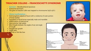 4/14/2018
71
TREACHER COLLINS – FRANCESCHETTI SYNDROME
• Synonym - Mandibulofacial dysostosis
• Autosomal dominant
• The gene of treacher Collin was mapped to chromosome 5q32-q33.1
• Clinical manifestations –
 Antimangoloid palpebral fissure with a coloboma of outer portion
of lower eyelids
 Hypoplasia of facial bones especially malar and mandible
 Malformation of external ear
 Macrostomia, high palate
 Blind fistulas between the angles of ear and angle
of mouth
 Atypical hair growth
 Facial clefts
 Bird like or fish like face
 