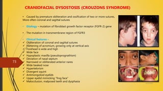 4/14/2018
73
CRANIOFACIAL DYSOSTOSIS (CROUZONS SYNDROME)
• Caused by premature obliteration and ossification of two or more sutures,
More often coronal and sagittal sutures
• Etiology – mutation of fibroblast growth factor receptor (FGFR-2) gene
• The mutation in transmembrane region of FGFR3
• Clinical features –
 Obliteration of coronal and sagittal sutures
 Flattening of acromium, growing only at vertical axis
 Forehead is wide and high
 Wide face
 Hypoplastic maxilla (pseudoprognathism)
 Deviation of nasal septum
 Narrowed or obliterated anterior nares
 Wide beaked nose
 Hypertelorism
 Divergent squint
 Antimongoloid eyelids
 Upper eyelid mimicking “frog face”
 Malocclusion, malposed teeth and dysphasia
 