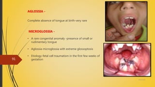 4/14/2018
91
AGLOSSIA -
Complete absence of tongue at birth-very rare
MICROGLOSSIA -
• A rare congenital anomaly -presence of small or
rudimentary tongue
• Aglossia-microglossia with extreme glossoptosis
• Etiology-fetal cell traumatism in the first few weeks of
gestation
 