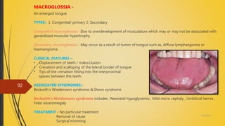 4/14/2018
92
MACROGLOSSIA -
An enlarged tongue
TYPES:- 1. Congenital/ primary 2. Secondary
Congenital macroglossia:- Due to overdevelopment of musculature which may or may not be associated with
generalized muscular hypertrophy
Secondary macroglossia: - May occur as a result of tumor of tongue such as, diffuse lymphangioma or
haemangioma.
CLINICAL FEATURES –
• Displacement of teeth / malocclusion.
• Crenation and scalloping of the lateral border of tongue
• Tips of the crenation fitting into the interproximal
spaces between the teeth.
ASSOCIATED SYNDROMES:-
Beckwith’s Wiedemann syndrome & Down syndrome
Beckwith’s Weidemann syndrome includes -Neonatal hypoglycemia , Mild micro cephaly , Umbilical hernia ,
Fetal visceromegaly
TREATMENT - No particular treatment
Removal of cause
Surgical trimming
 