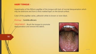 4/14/2018
98
HAIRY TONGUE -
Hypertrophy of the filiform papillae of the tongue with lack of normal desquamation which
may be extensive and form a thick matted layer on the dorsal surface.
Color of the papillae varies, yellowish white to brown or even black.
Etiology - Candida albicans
TREATMENT - Brush the tongue to promote
desquamation and remove the debris.
 