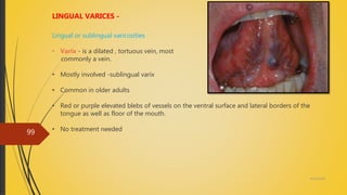 4/14/2018
99
LINGUAL VARICES -
Lingual or sublingual varicosities
• Varix - is a dilated , tortuous vein, most
commonly a vein.
• Mostly involved -sublingual varix
• Common in older adults
• Red or purple elevated blebs of vessels on the ventral surface and lateral borders of the
tongue as well as floor of the mouth.
• No treatment needed
 