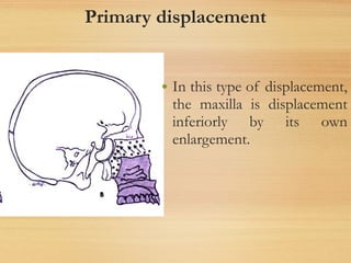 Primary displacement
• In this type of displacement,
the maxilla is displacement
inferiorly by its own
enlargement.
 