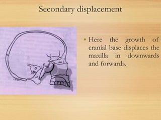 Secondary displacement
• Here the growth of
cranial base displaces the
maxilla in downwards
and forwards.
 