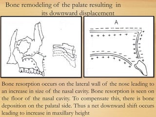 Bone remodeling of the palate resulting in
its downward displacement
Bone resorption occurs on the lateral wall of the nose leading to
an increase in size of the nasal cavity. Bone resorption is seen on
the floor of the nasal cavity. To compensate this, there is bone
deposition on the palatal side. Thus a net downward shift occurs
leading to increase in maxillary height
 