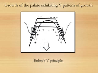 Enlow’s V principle
Growth of the palate exhibiting V pattern of growth
 