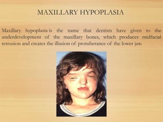 MAXILLARY HYPOPLASIA
Maxillary hypoplasia is the name that dentists have given to the
underdevelopment of the maxillary bones, which produces midfacial
retrusion and creates the illusion of protuberance of the lower jaw.
 