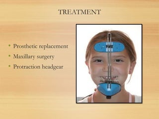 TREATMENT
• Prosthetic replacement
• Maxillary surgery
• Protraction headgear
 