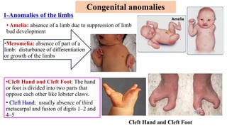 1-Anomalies of the limbs
•Cleft Hand and Cleft Foot: The hand
or foot is divided into two parts that
oppose each other like lobster claws.
• Cleft Hand; usually absence of third
metacarpal and fusion of digits 1–2 and
4–5
Congenital anomalies
Cleft Hand and Cleft Foot
Amelia
• Amelia: absence of a limb due to suppression of limb
bud development
•Meromelia: absence of part of a
limb: disturbance of differentiation
or growth of the limbs
 