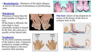 •Syndactyly
•Is the most common anomaly
of the hand or foot. Cutaneous
syndactyly (simple webbing
between digits) is the most
common limb anomaly.
• Brachydactyly: Shortness of the digits (fingers
or toes) is the result of disturbance in proliferating
zone
•Polydactyly
•Presence of more than the
usual number of fingers or
toes.
•If the hand is affected, the
extra digit is most
commonly medial or lateral.
In the foot, the extra toe is
usually on the lateral side.
Flat foot: failure of development of
arches of the bones of the foot or
collapse later in life
 
