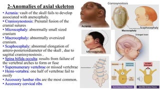 2-Anomalies of axial skeleton
• Acrania: vault of the skull fails to develop
associated with anencephaly.
• Craniosynostosis: Prenatal fusion of the
cranial sutures
• Microcephaly: abnormally small sized
cranium
• Macrocephaly: abnormally oversized
cranium.
• Scaphocephaly: abnormal elongation of
antero-posteriordiameter of the skull , due to
sagittal craniosynostosis .
• Spina bifida occulta: results from failure of
the vertebral arches to form or fuse
• Supernumerary vertebrae or missed vertebrae
• Hemi-vertabra: one half of vertebrae fail to
ossify
• Accessory lumbar ribs are the most common.
• Accessory cervical ribs
Acrania
Craniosynostosis
Microcephaly
Scaphocephaly
 